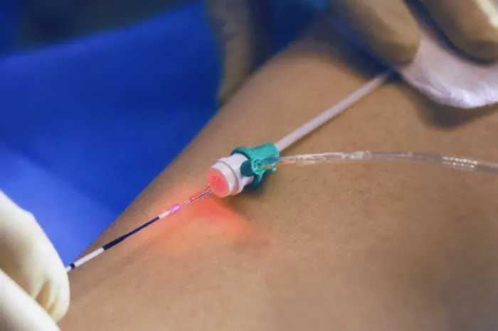 Fibra de laser sendo introduzida na veia da perna durante o endolaser